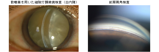 (左)散瞳薬を用いた細隙灯顕微鏡検査（白内障） (右)前房隅角検査