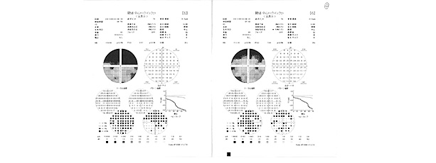 視野検査