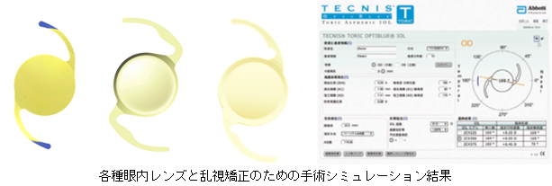 各種眼内レンズと乱視矯正のための手術シミュレーション結果