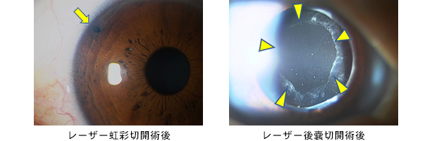 (左)レーザー虹彩切開術後　(右)レーザー後嚢切開術後