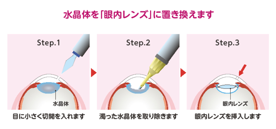 水晶体を「眼内レンズ」に置き換えます