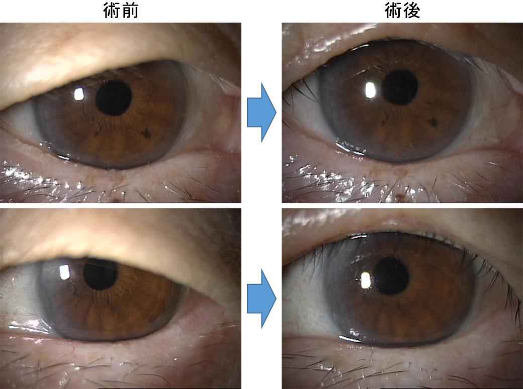 上眼瞼皮膚切除手術症例写真