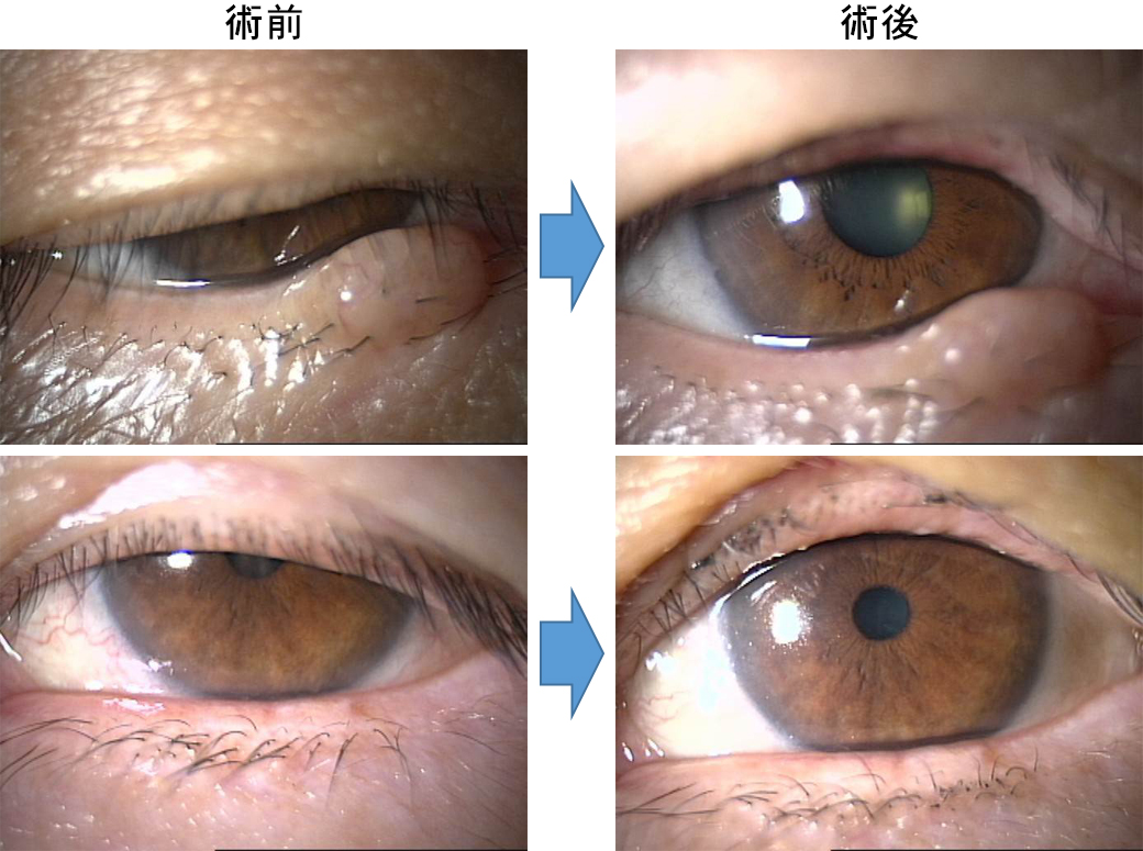 挙筋短縮術手術症例写真